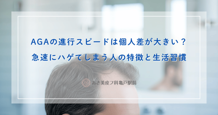 AGAの進行スピードは個人差が大きい？急速にハゲてしまう人の特徴と生活習慣