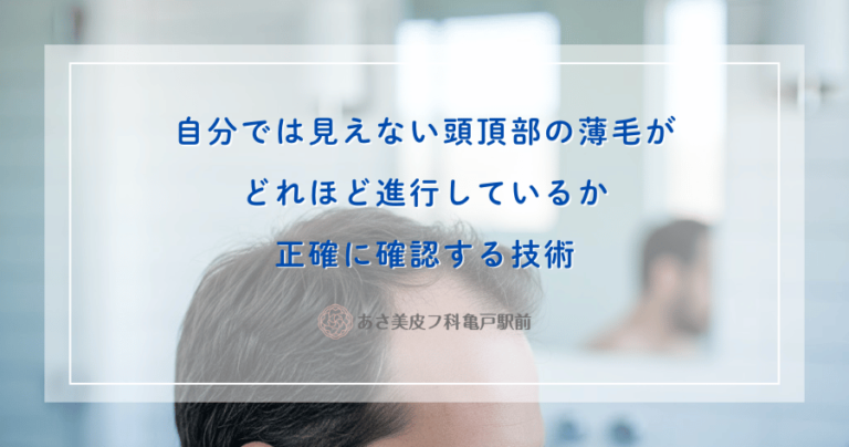 自分では見えない頭頂部の薄毛がどれほど進行しているか正確に確認する技術