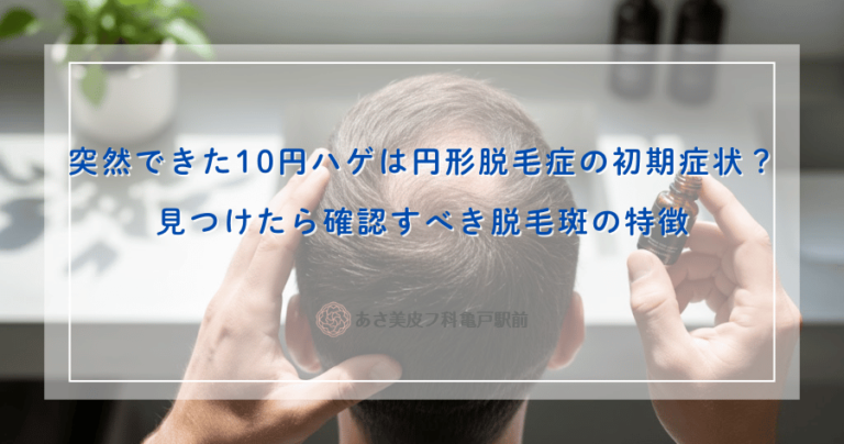 突然できた10円ハゲは円形脱毛症の初期症状？見つけたら確認すべき脱毛斑の特徴
