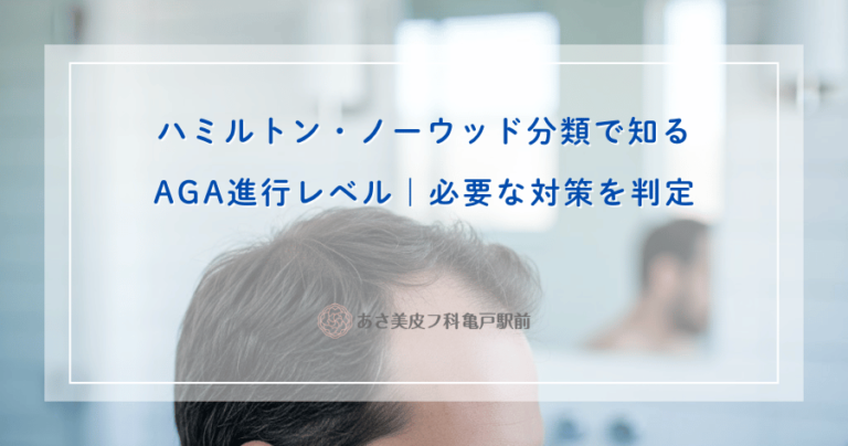 【セルフチェック付】ハミルトン・ノーウッド分類でAGA進行度を判定｜正しい対策完全ガイド