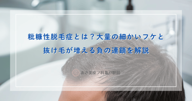 粃糠性脱毛症とは？大量の細かいフケと抜け毛が増える負の連鎖を解説