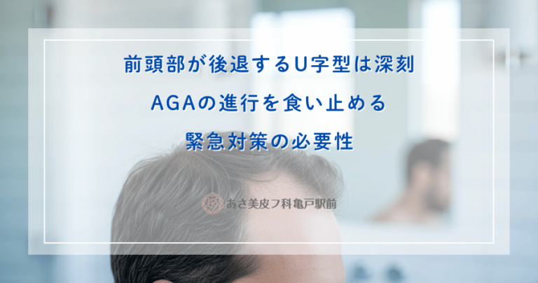 前頭部が後退するU字型は深刻｜AGAの進行を食い止める緊急対策の必要性