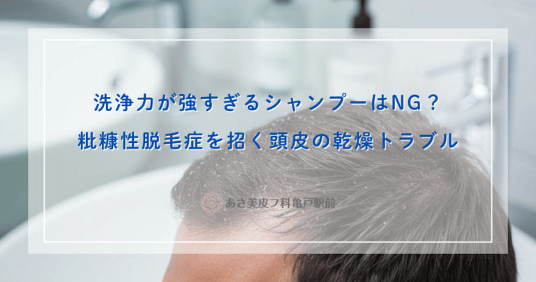 洗浄力が強すぎるシャンプーはNG？粃糠性脱毛症を招く頭皮の乾燥トラブル