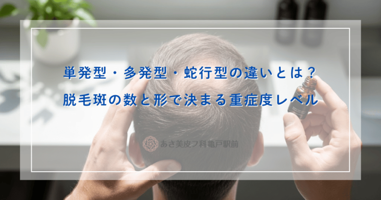 単発型・多発型・蛇行型の違いとは？脱毛斑の数と形で決まる重症度レベル
