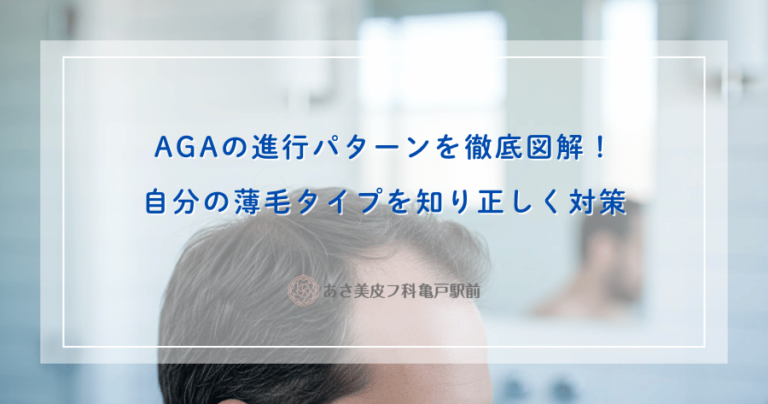AGAの進行パターンを徹底図解！自分の薄毛タイプを知り正しく対策
