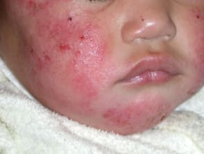 乳児期のアトピー性皮膚炎