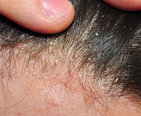 水泳選手のかゆみの症状は何ですか?